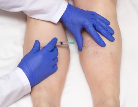 Doctor in medical gloves injects sclerotherapy procedure on the legs of a woman against varicose veins, close-up, ozone therapy